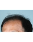 Before Hair Transplant&nbsp;2 Sessions (Areas)